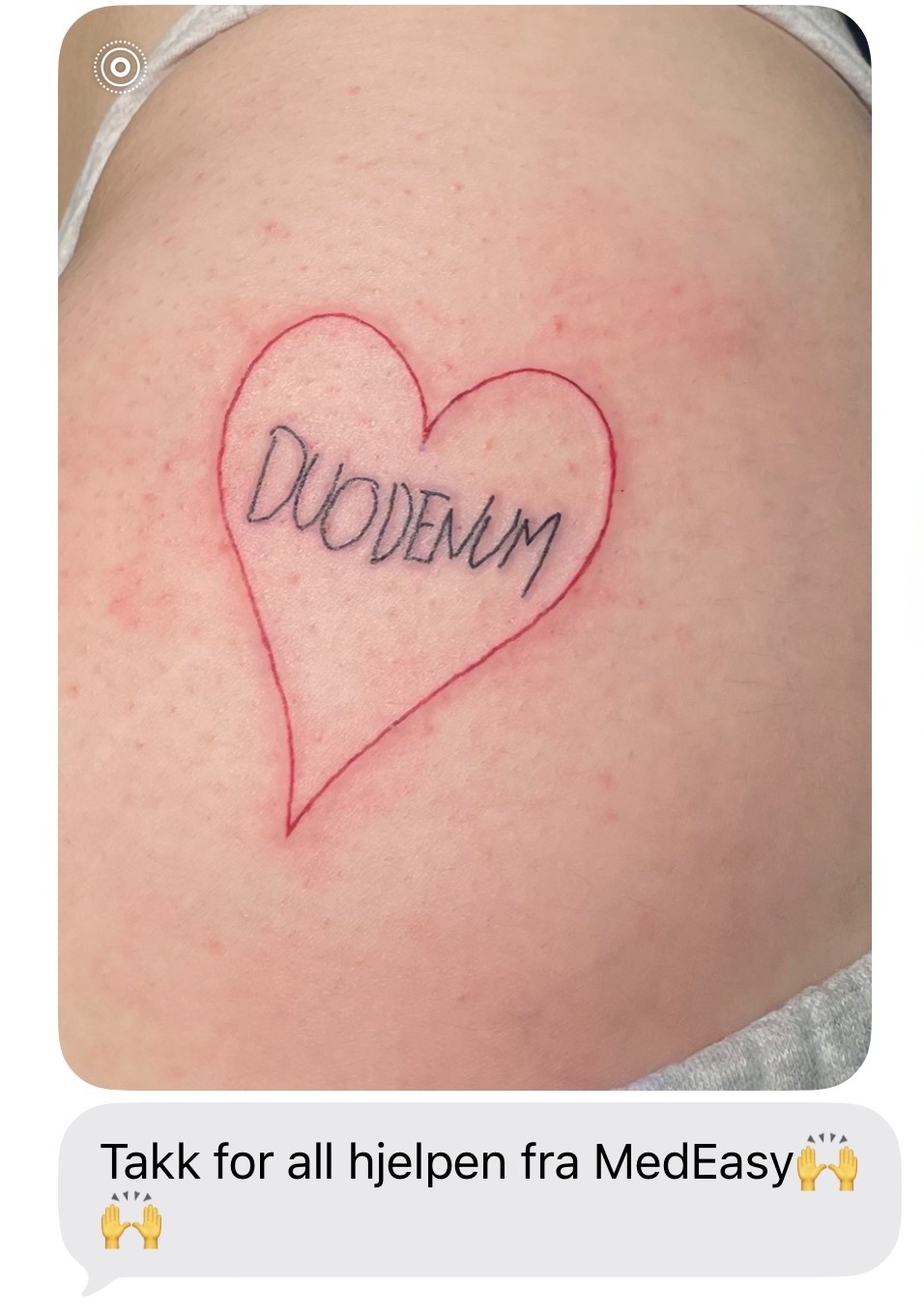 Bilde av en I love duodenum-tattovering